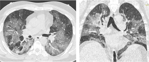 Axial and coronal sections of CT showed diffuse Ground glass opacification with areas of 'Crazy Paving' indicating towards the late phase of disease.