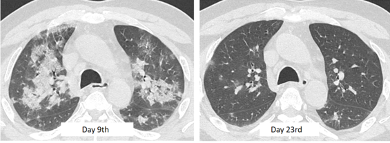 Progressive improvement in patient’s condition after aggressive medical treatment as predicted on HRCT Thorax.