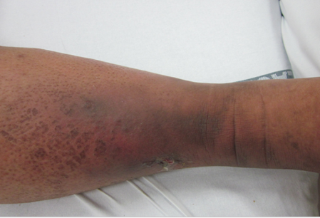 Leg indurated, edematous, non-pitting, blackening