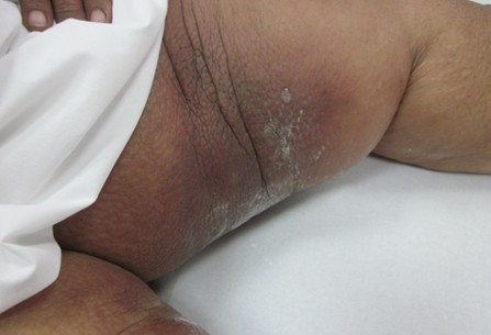 Thigh, edematous, non-pitting, blisters