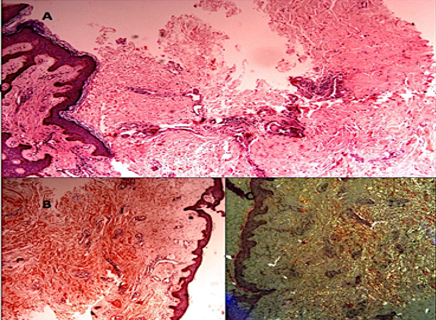 Histopathology A) Skin biopsy Hematoxylin & Eosin 20 X. Dermis is markedly expanded by thickened collagen bundles, not accompanied by increase in number of fibroblasts. Stains for Amyloid were negative. (B) Congo Red stain and C) Polarized microscopy, no apple green birefringence
