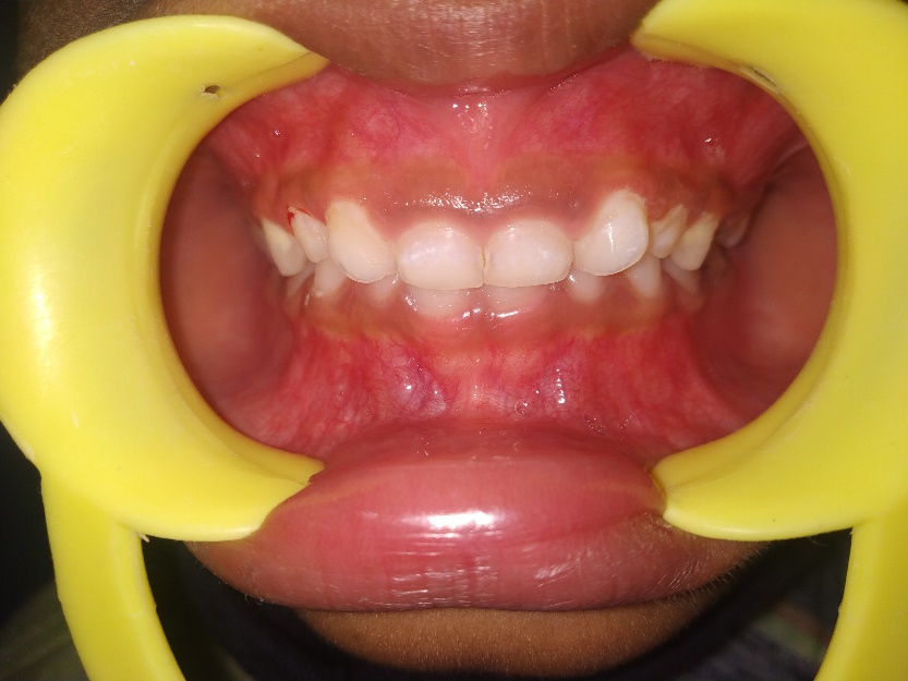 Intraoral Photograph