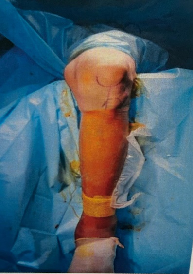 Intra-operative picture showing incision site for infrapatellar nailing approach