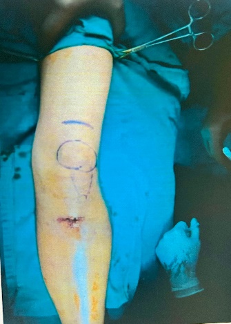 Intra-operative picture showing incision site for suprapatellar nailing approach