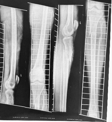 Pre- operative picture showing proximal tibia fracture