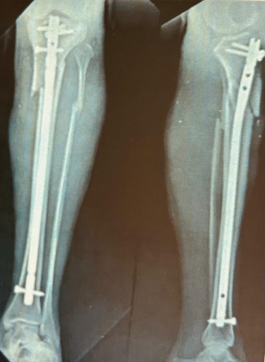 Immediate post- operative