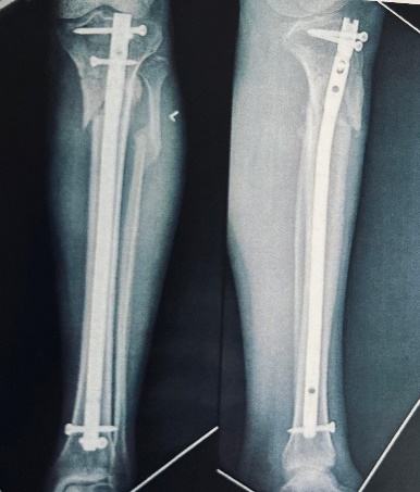 X-ray at 6 month follow up