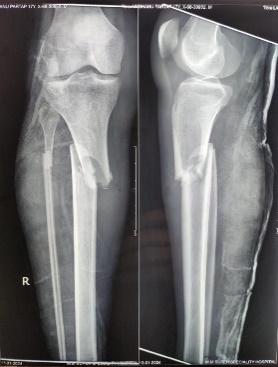 X-ray at the time of presentation (pre-op)