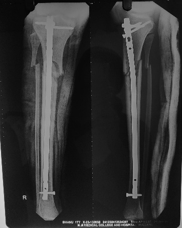 Immediate post op xray