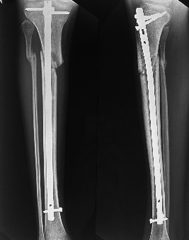 X-ray at 6 month follow up