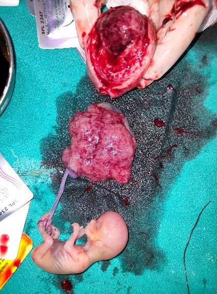 Resected rudimentary horn cut open showing fetus inside with placenta