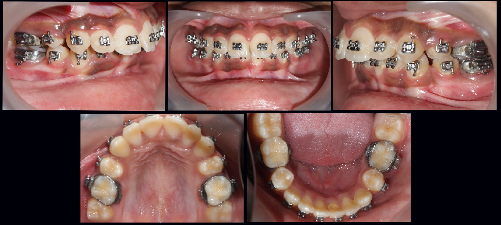 Intraoral photographs after 0.019X0.025 SS wire stage