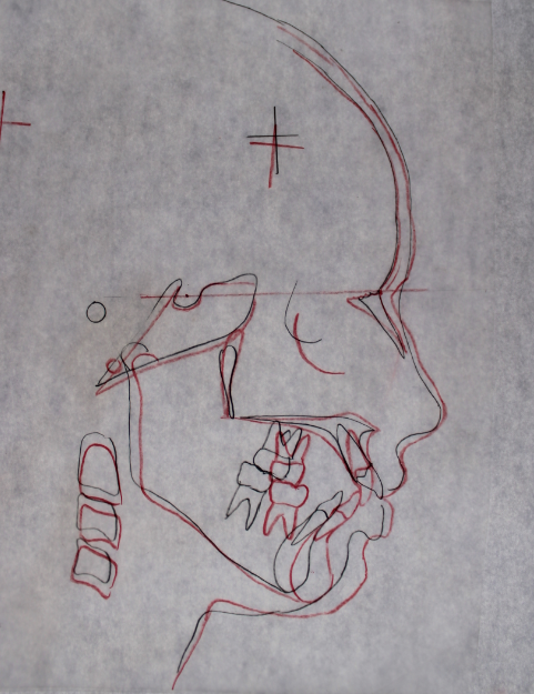 Superim position of pre-treatment (black) and post-treatment (red) cephalogram