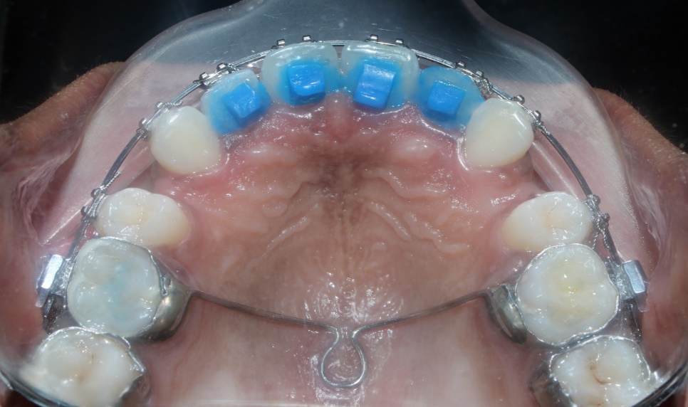 Anterior bite turbos