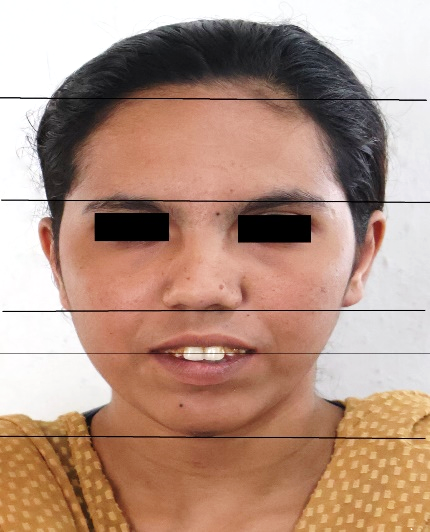 Excessive lower facial
