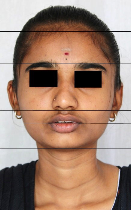 Diminished lower facial