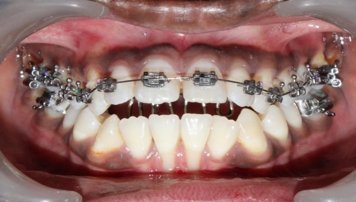Tongue crib