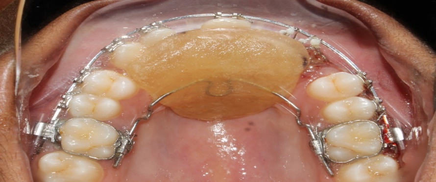 Anterior bite plane