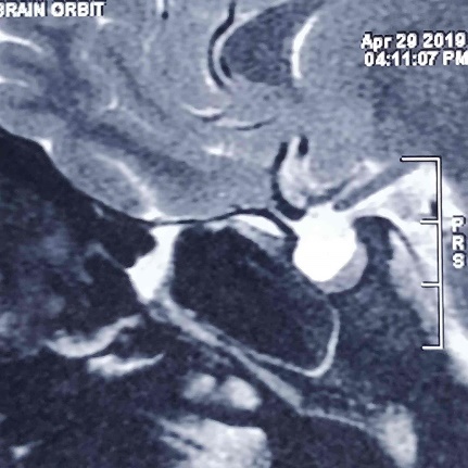 MRI brain shows emptysella with flattened pituitary gland