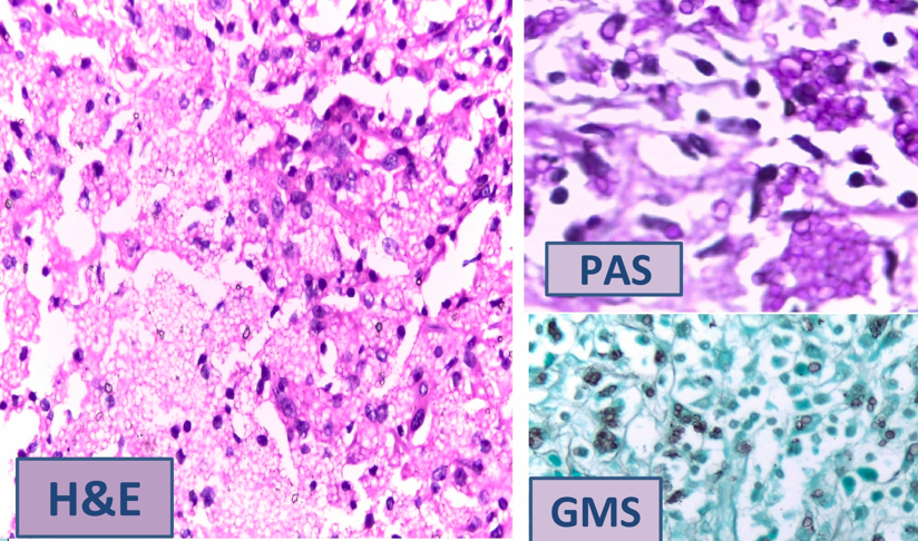 H&E sections from adrenal gland showing budding yeast forms; special stains for fungi-PAS & GMS