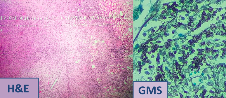 H&E section showing renal cortical tissue with fungal forms highlighted with special stains