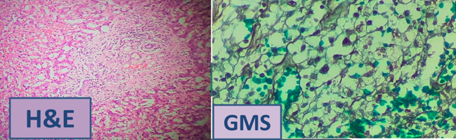 H&E section of liver tissue and budding yeast forms in GMS