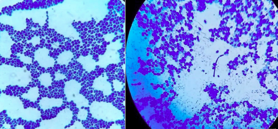 Grams stain showing Candida yeast forms