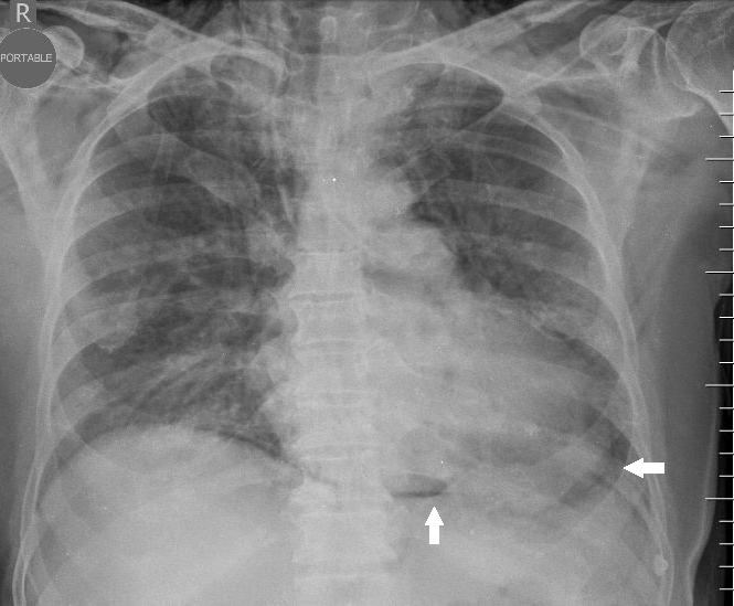 Air leak syndrome in COVID19 A case series IJIRM