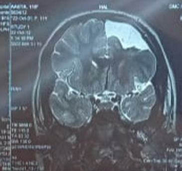 MRI showing porencephaly left frontal lobe and left hippocampal atrophy.