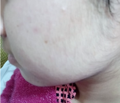 Facial hair growth due to carbamazepine induced central hypothyroidism.