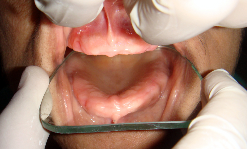 Labially inclined (excessively bulky) maxillary edentulous ridge