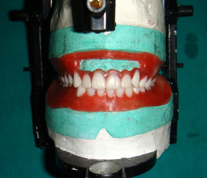 Complete teeth arrangement