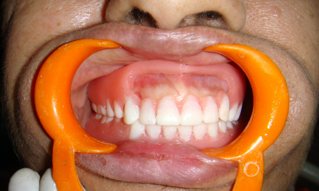 Window denture – in patient