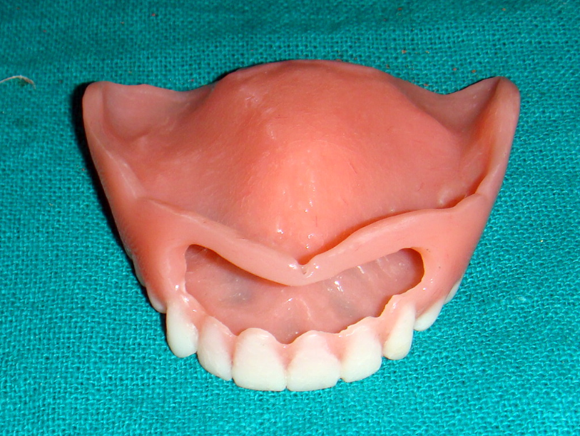 Window denture An unconventional approach for the bulky edentulous