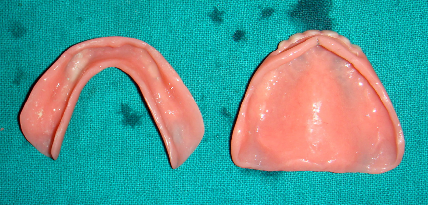 Complete dentures – intaglio surface