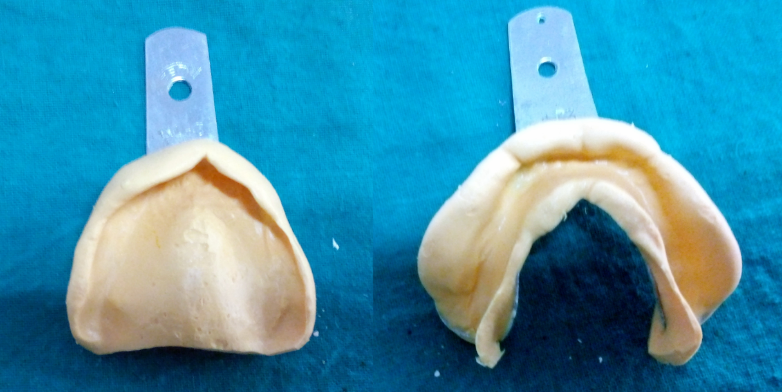 Preliminary impression – maxillary & mandibular