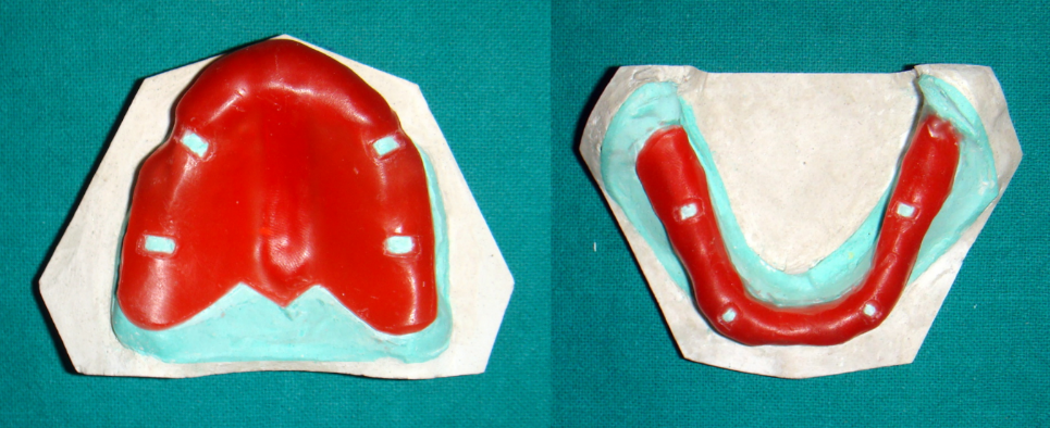 Wax spacer adaptation – maxillary & mandibular