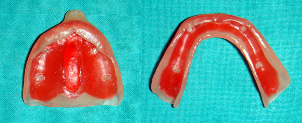 Special Tray – maxillary & mandibular