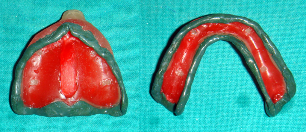 Border Moulding – maxillary & mandibular