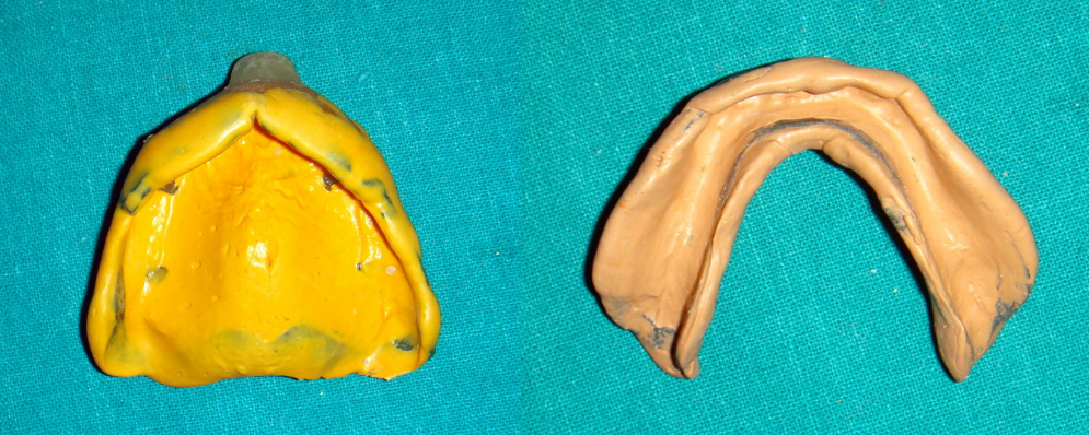 Final impression – maxillary & mandibular