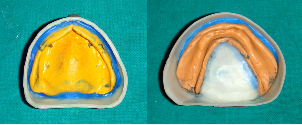 Beading & boxing – maxillary & mandibular