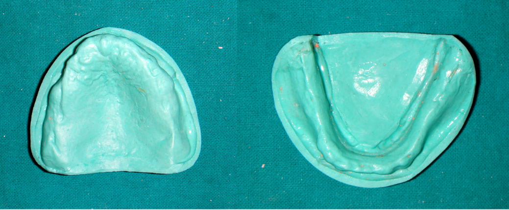 Definitive cast – maxillary & mandibular