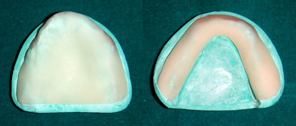 Temporary record base - – maxillary & mandibular