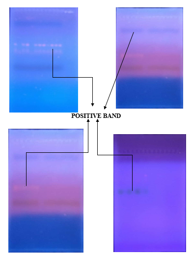 Electrophoresis showing positive band of pathogenic MYOC gene variant