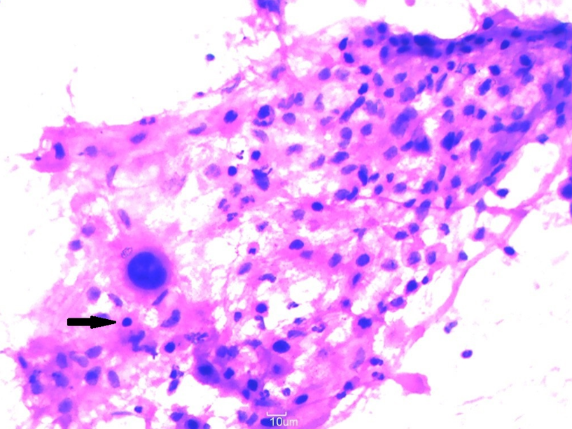 Cell aggregates showingsquamous differentiation typified by atypical keratinized cells with dense eosinophilic cytoplasm and pyknotic nuclei (arrow) (H&E, 40X)