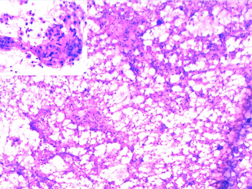 Sheets and dispersed atypical squamous cells lying in a background of acute inflammation. (H&E-10X) {Inset: high power view of atypical squamous cells and tadpole cells}