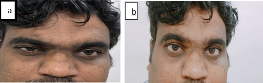  Image of the patient before ice pack test; Image of the patient after ice pack test 