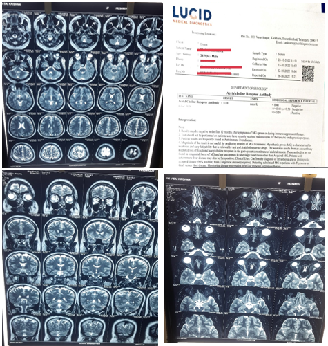 MRIbrain of the patient 