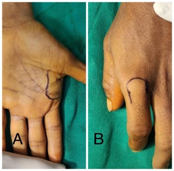 A: Metacarpal head; B: Proximal Phalynx base marked