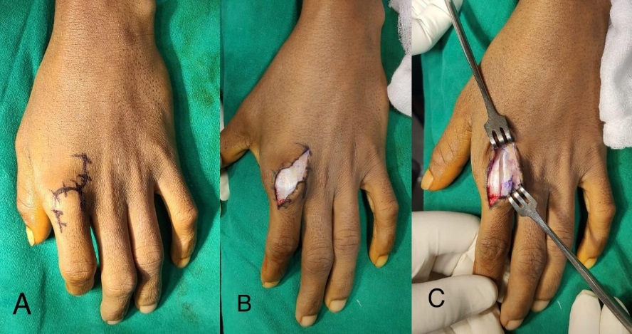 A: Curvilinear incision marked; B: Curvilinear skin Incision; C: Longitudinal incision over extensor mechanism and joint capsule